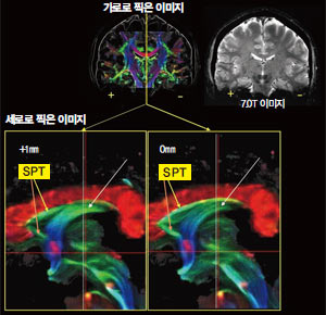 이번에 새롭게 발견된 신경섬유 SPT 사진. 살아있는 사람의 뇌를 종단면으로 촬영한 이미지(위쪽 오른편)에 특수 프로그램 DTI를 이용하면 신경섬유의 방향에 따라 다른 색으로 표현된다(위쪽 왼편). 아래는 뇌의 시상 부분을 횡단면으로 촬영한 이미지로, 1mm 단위로 촬영하자 숨어있던 신경섬유 SPT가 선명하게 나타난다. 조장희 박사에 의하면 SPT는 긍정적 감정을 관장하는 고리에 해당하는 신경섬유다.