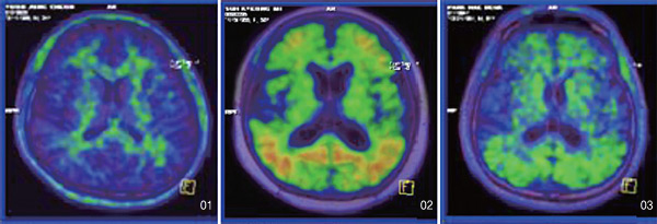 지대윤 교수팀이 개발한 알츠하이머병 진단약 ‘FC119S’을 이용해 PET 스캐너로 찍은 환자의 뇌 영상.①은 정상인의 뇌이고 ②는 알츠하이머병 환자의 뇌, ③은 알츠하이머병 초기 환자의 뇌 영상이다.