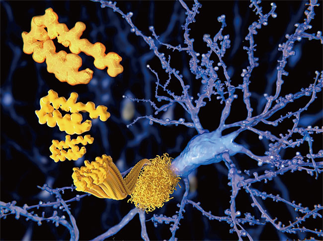 베타 아밀로이드 단백질이 응집돼 있는 알츠하이머 환자의 뇌. ⓒphoto 셔텨스톡