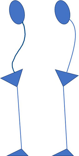골반이 앞쪽으로 기울어지면서 무게 중심을 맞추기 위해 허리는 과도하게 젖혀지고 등뼈는 굽은 경우(왼쪽). 골반이 뒤로 기울어지면 척추 전체가 평평해지고 흉추 윗부분과 경추(목뼈)가 앞으로 과도하게 굽는 경우(오른쪽). ⓒphoto 이우제