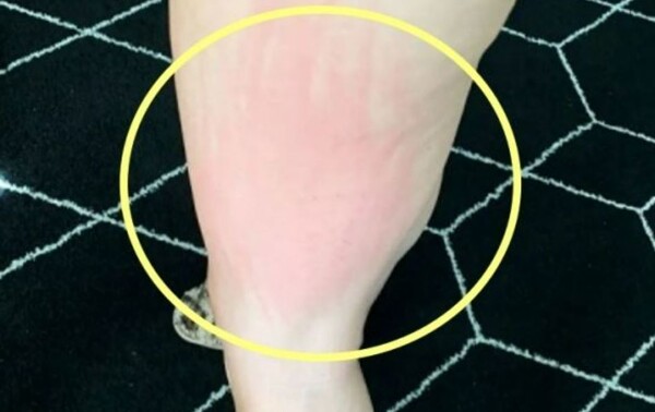 정액 알레르기로 인해 빨갛게 부은 앨리슨 테니슨(34). photo 더선 SNS 캡쳐